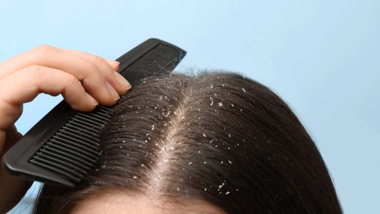 Adiós a la caspa: el truco simple con aceite de coco y laurel que la elimina definitivamente y fortalece tu cabello